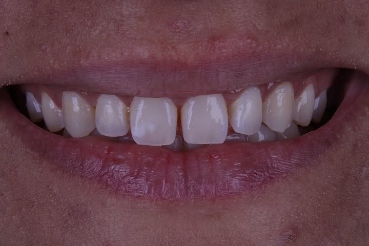 Antes do tratamento 4