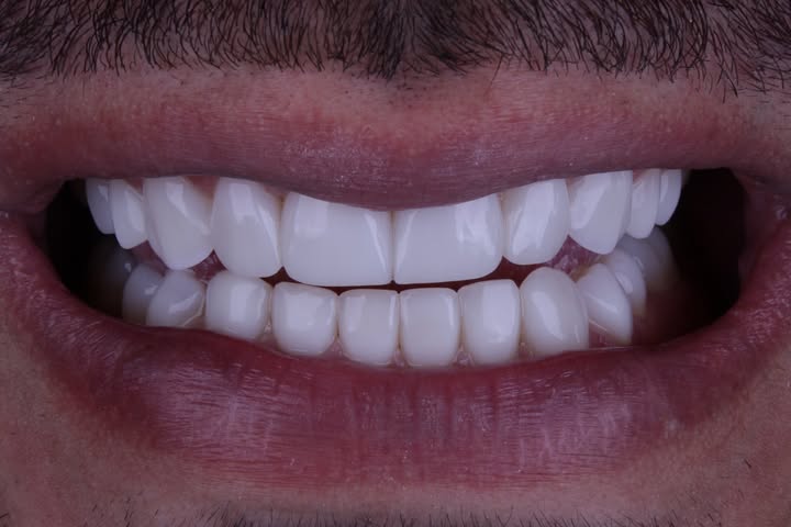 Depois do tratamento 1