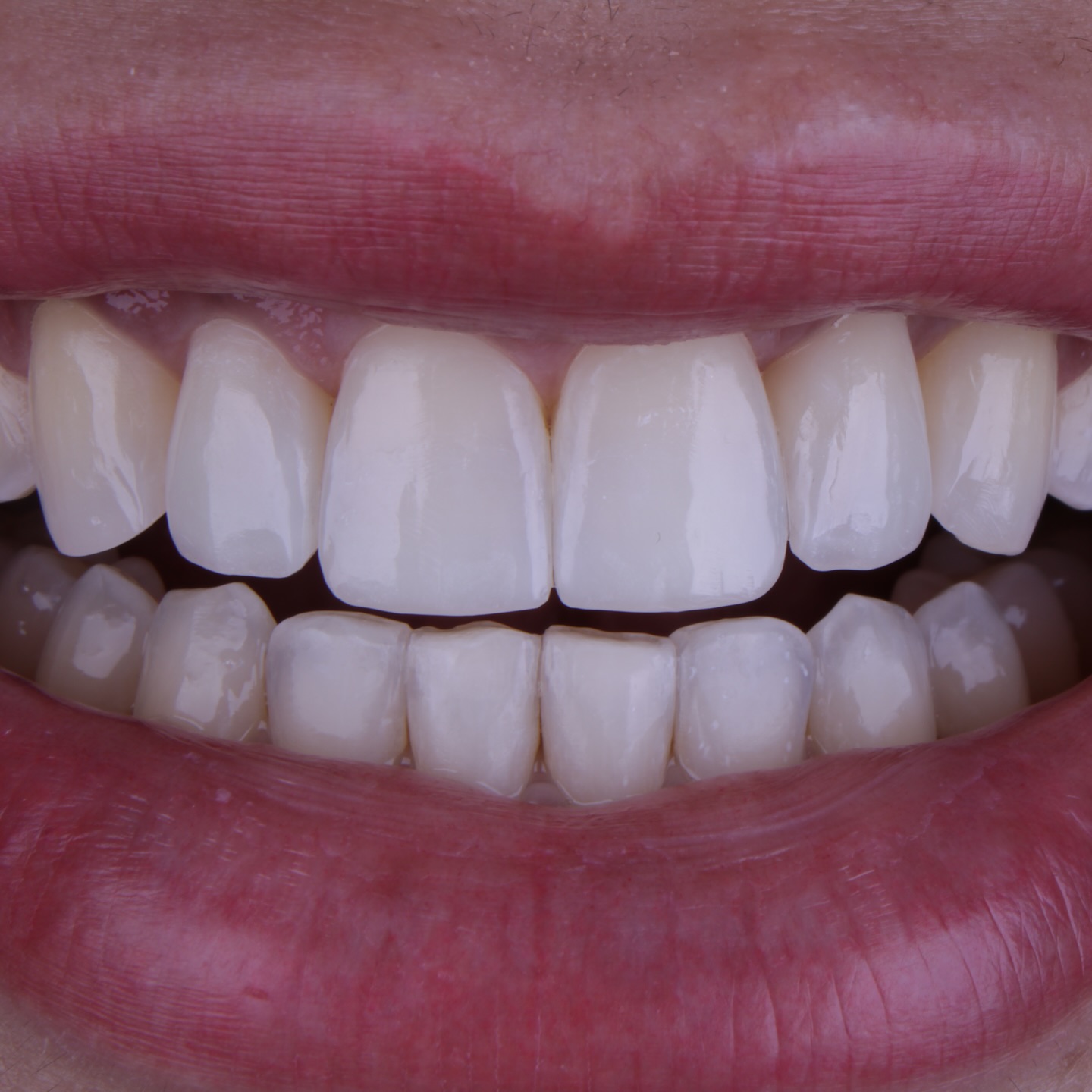 Depois do tratamento 2