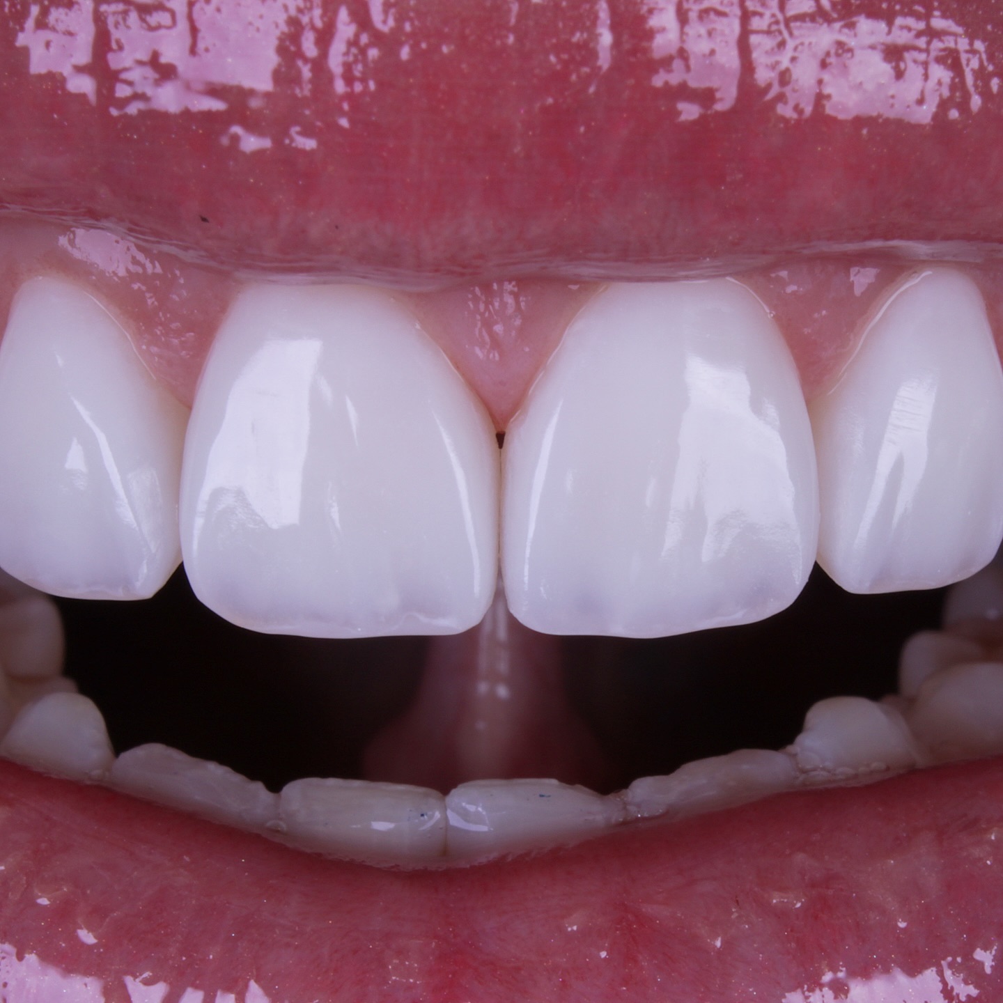 Depois do tratamento 3