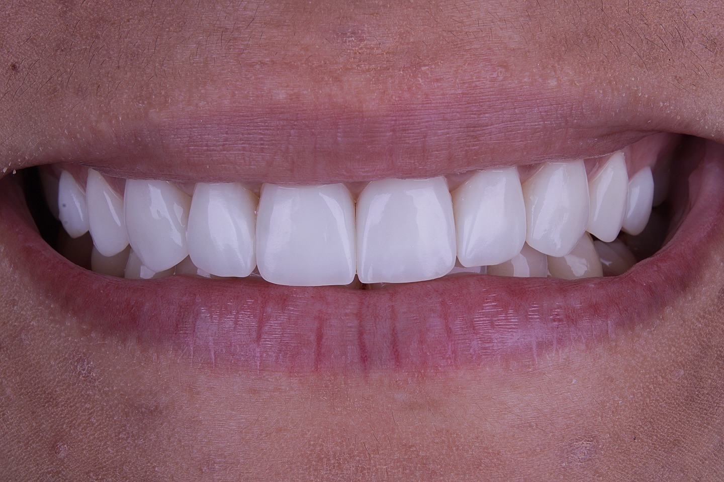 Depois do tratamento 4