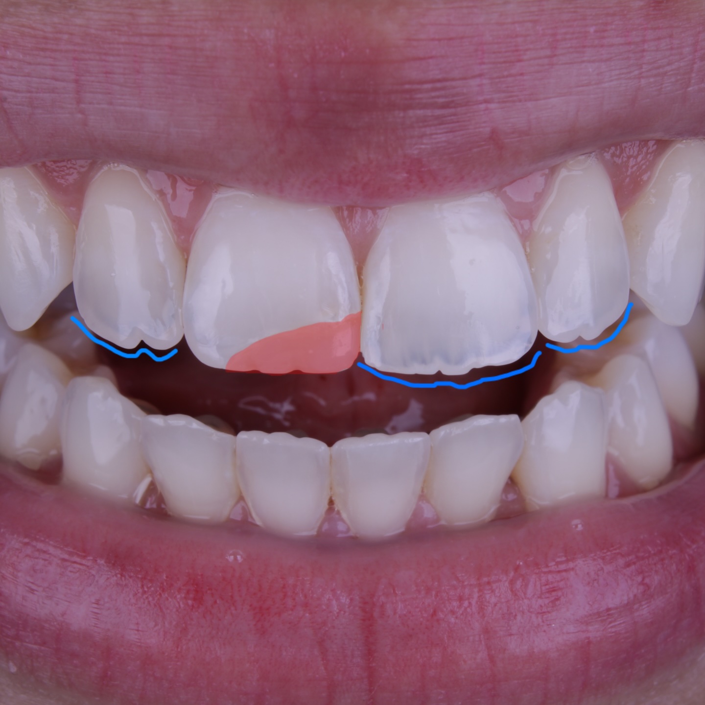 Restaurações estéticas